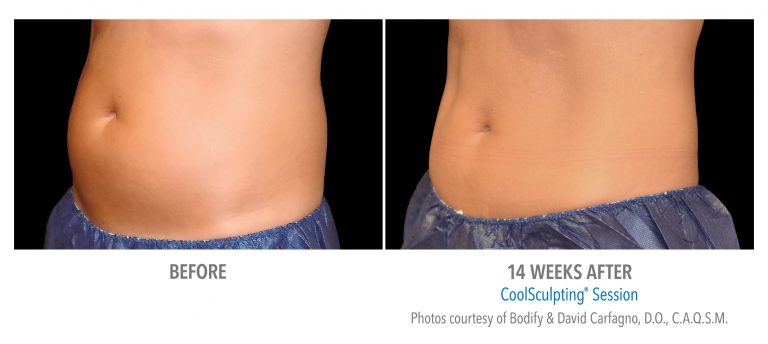 before and after coolsculpting